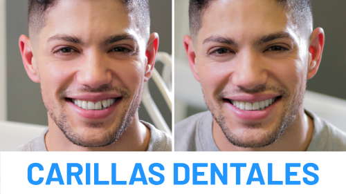 David Lafuente - Carillas Dentales
